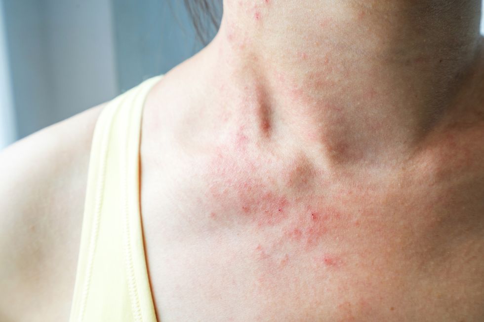 A young woman in a yellow tank top with a skin rash itch on her neck