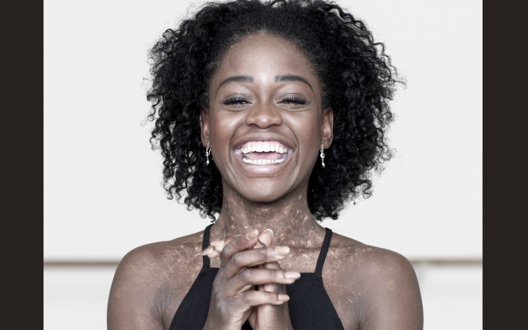 Exclusive: After Suffering a Ruptured Achilles Tendon, Michaela DePrince is Bouncing Back
