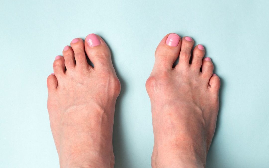 The Best Ways to Prevent Blisters from Pointework