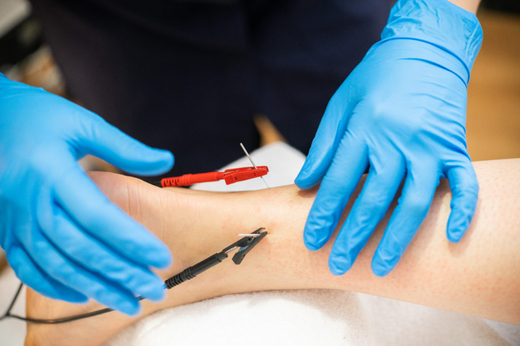 Close-up ohoto shows a physical therapist's gloved hands attach electrical stimulation during a dry needling session on a woman's leg.