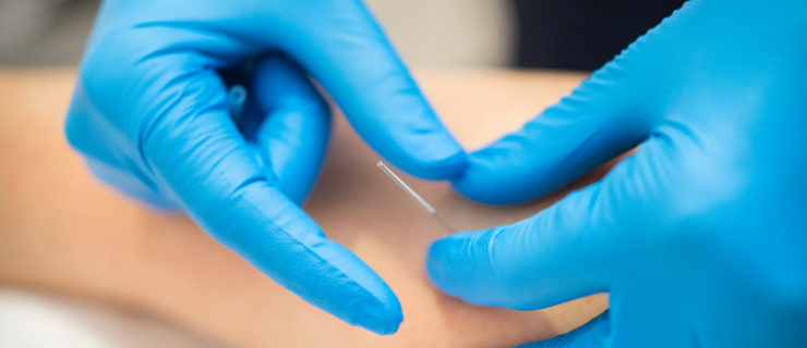 In this close-up photo, the gloved hands of a physical therapist adjusts a needle in a patient's leg during a dry needling session.