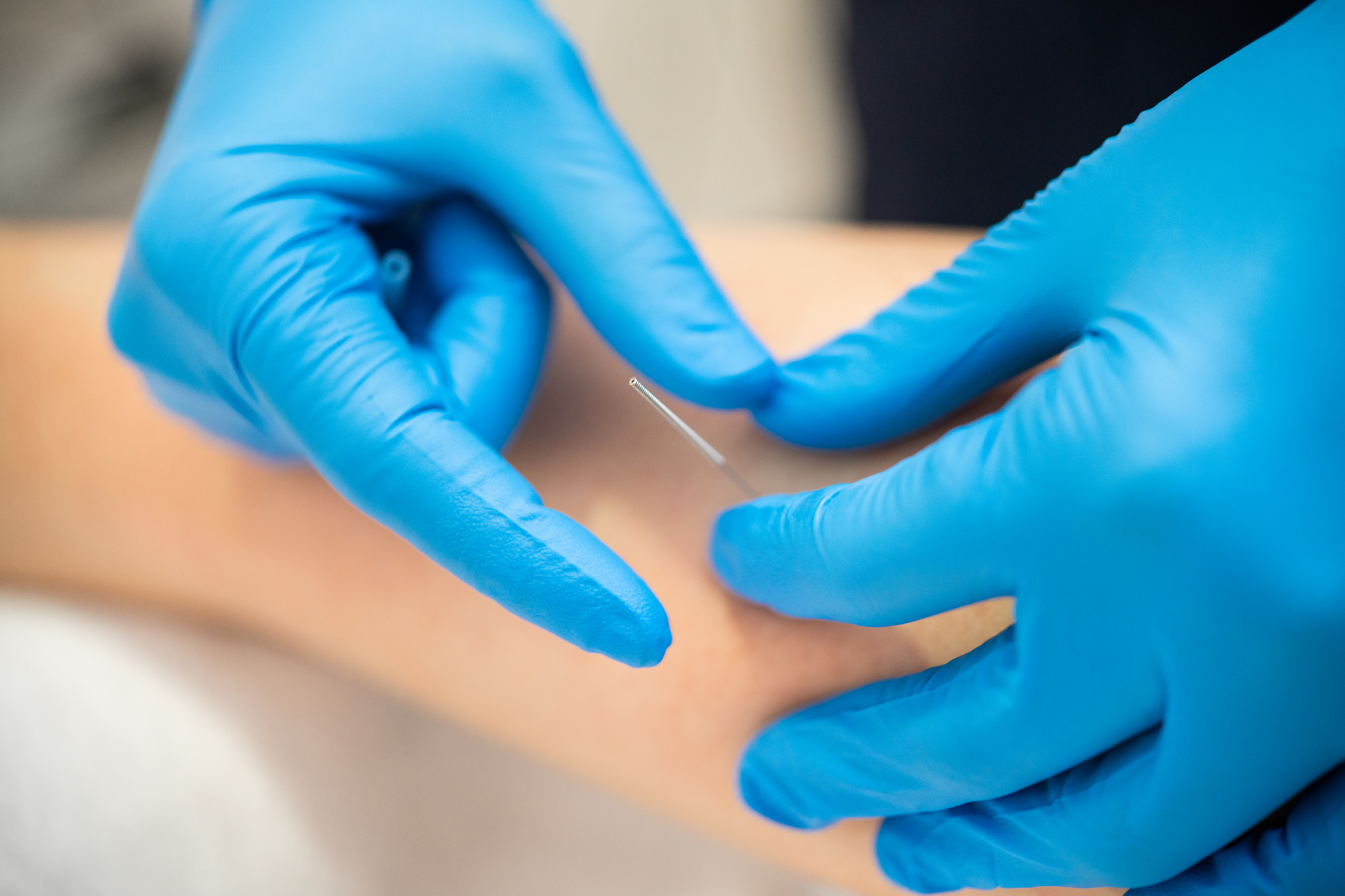 In this close-up photo, the gloved hands of a physical therapist adjusts a needle in a patient's leg during a dry needling session.