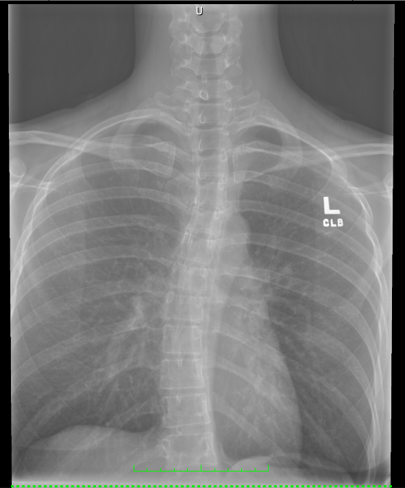 A black and white X-ray image shows a female dancer's spine, ribcage and shoulder girdle from the mid-back up to the neck. The dancer has scoliosis, so her thoracic spine curves slightly to the left and twists.