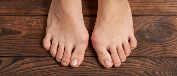 A photo of two bare feet with bunions on a wood floor.