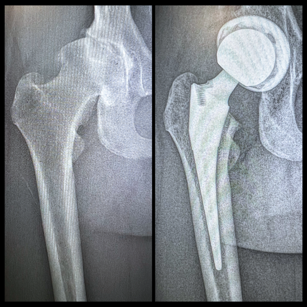 Two X-rays of a dancer's right hip are shown side by side. The one on the right shows a hip bone deteriorated by arthritis. The one of the left shows the same hip with a metal hip replacement, including the ballet and socket and an arm that extends down into the femur bone.