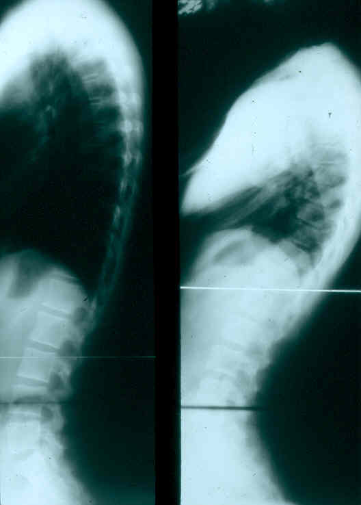 Two x-ray views of a fractured lumbar vertebra, set side-by-side.