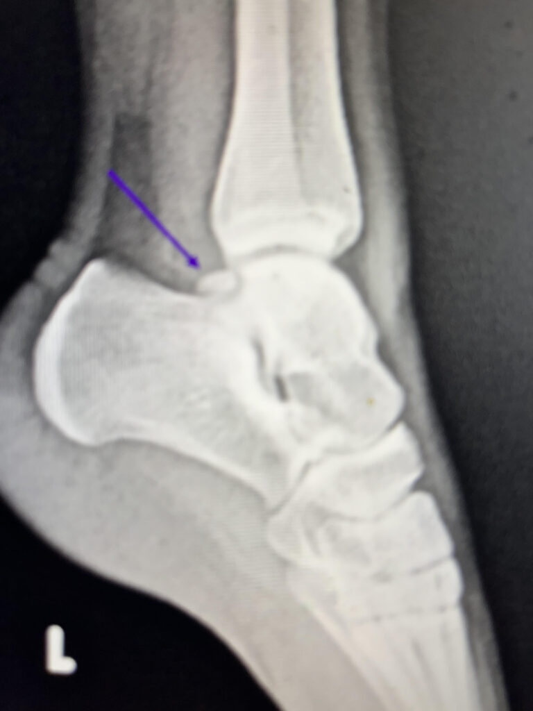 An x-ray of the left side showing an os trigonum (small extra bone in the heel).