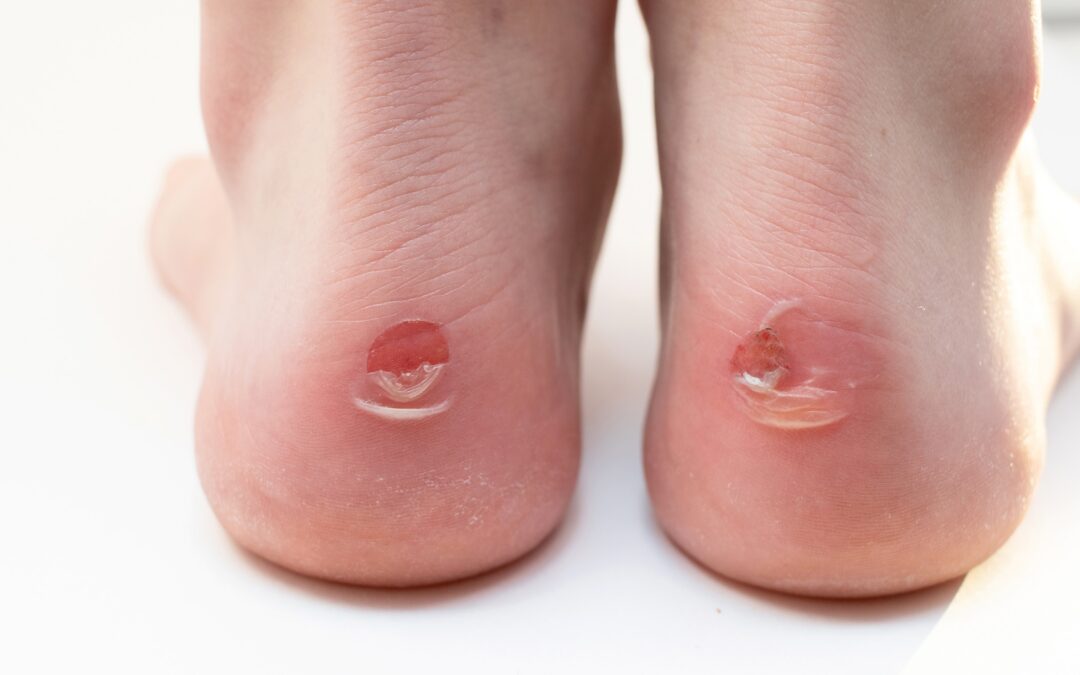 Heel Blisters Are the Worst—Here’s How to Deal With Them